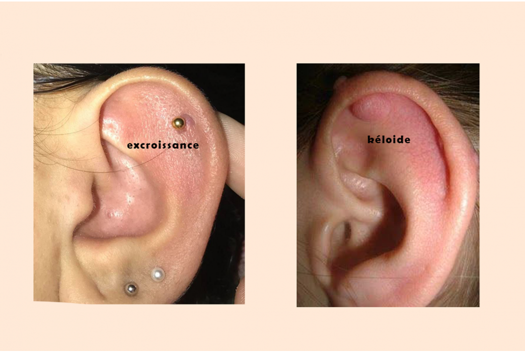 CHELOIDE OU EXCROISSANCE APRES UN PIERCING : COMMENT FAIRE LA DIFFERENCE ?