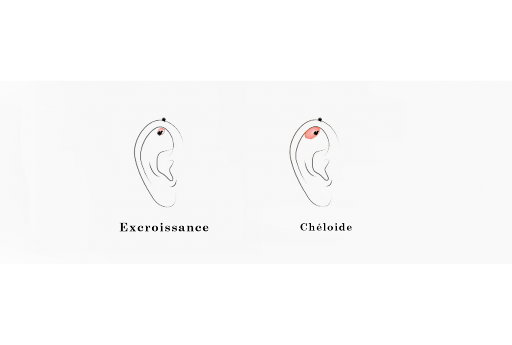 CHELOIDE OU EXCROISSANCE APRES UN PIERCING : COMMENT FAIRE LA DIFFERENCE ?